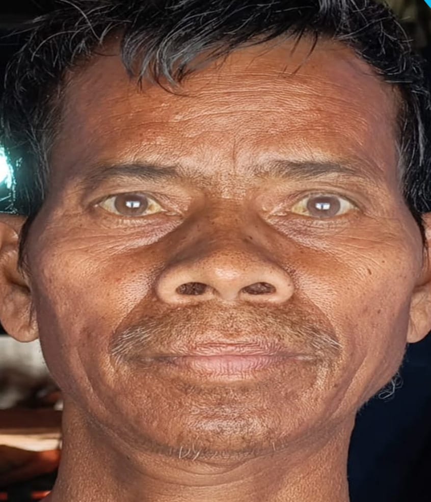 ଯକ୍ଷ୍ମା ରୋଗରେ ପୀଡିତ ରମେଶ, ଚିକତ୍ସା ପାଇଁ ଅର୍ଥ ସାଜିଛି ବାଧକ