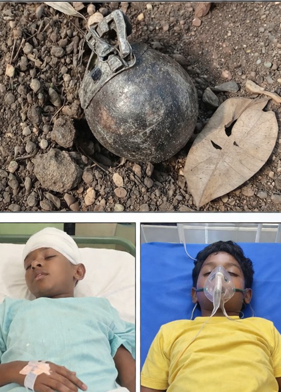 ବୋମା ବିସ୍ଫୋରଣ ରେ ଦୁଇ ନାବାଳକ ଗୁରୁତର।